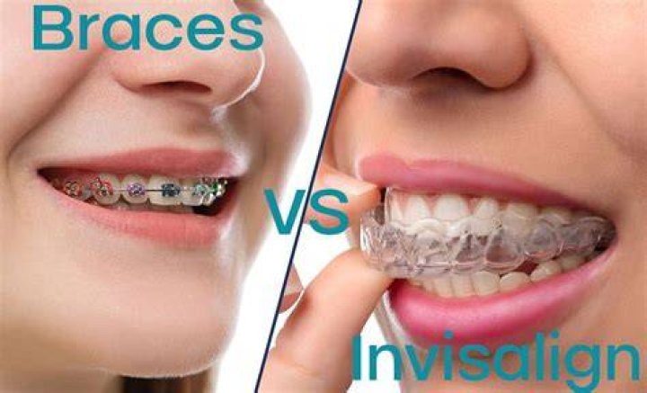 Are Damon braces better than Invisalign?