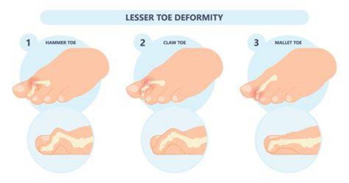 What does Lesser toe mean?
